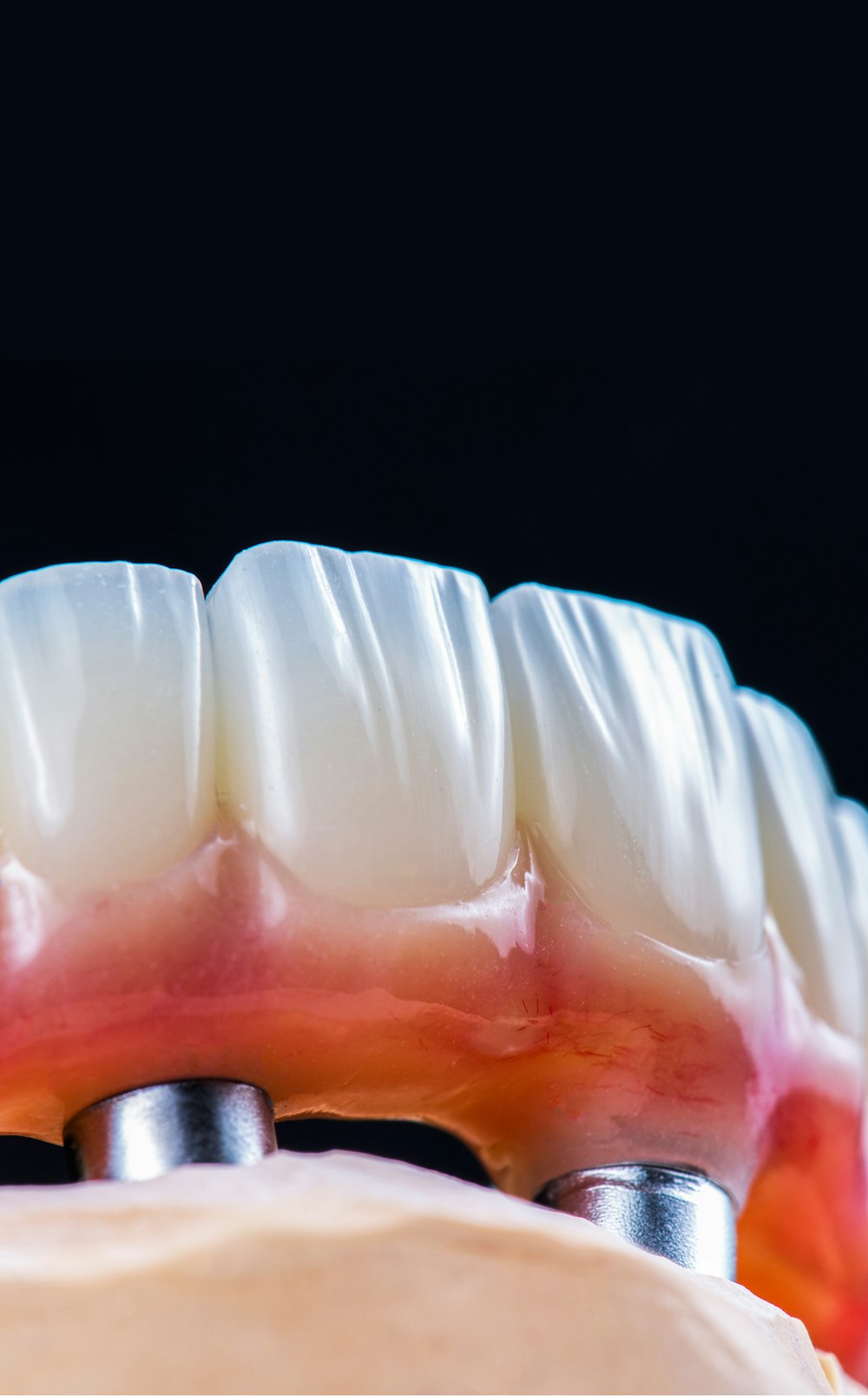 All-on-4 denture