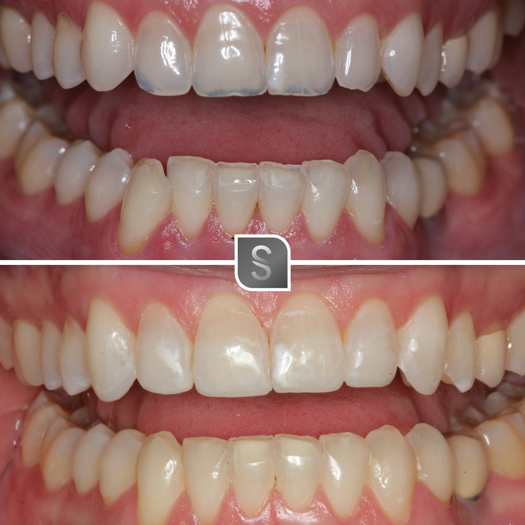 Case 16 before and after Invisalign