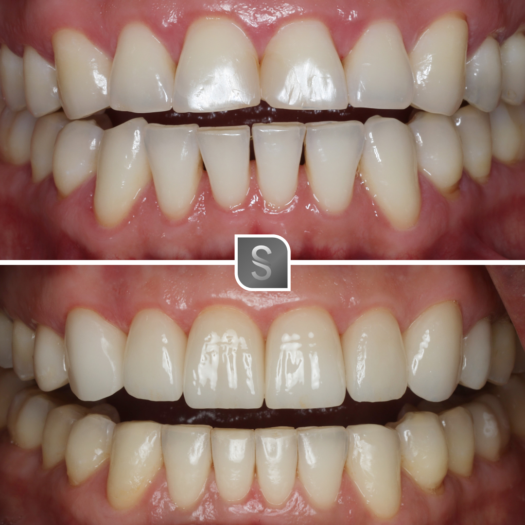 Case 22 before and after Invisalign