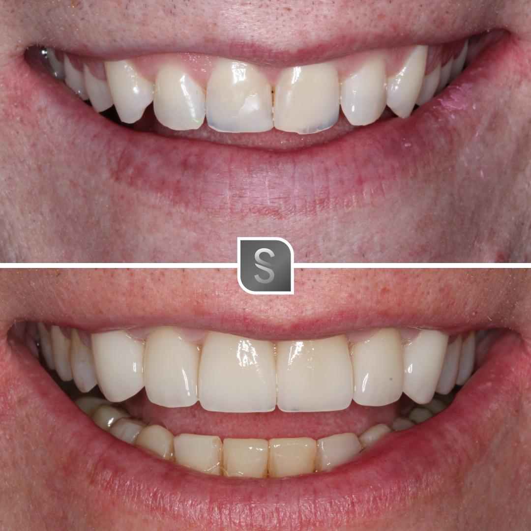 Case 21 before and after Invisalign
