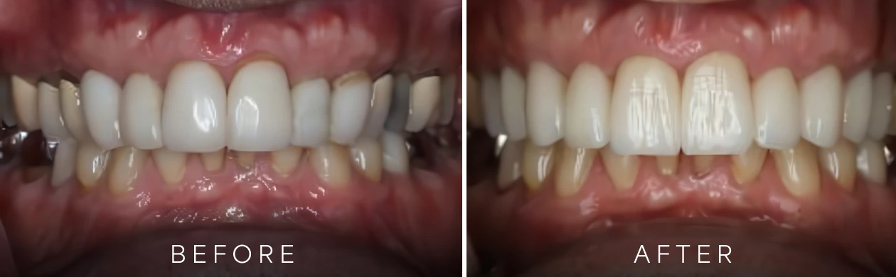 Patient results before and after crowns