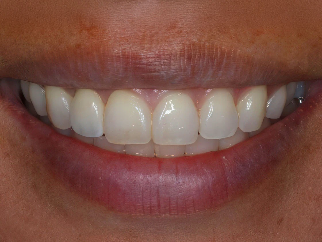 After image of patient with dental implants