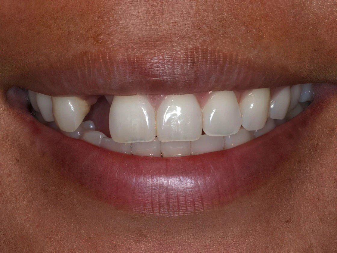 Before image of patient with dental implants