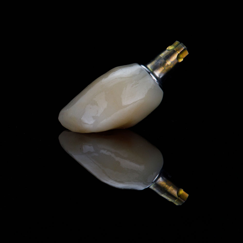 Dental implant with crown