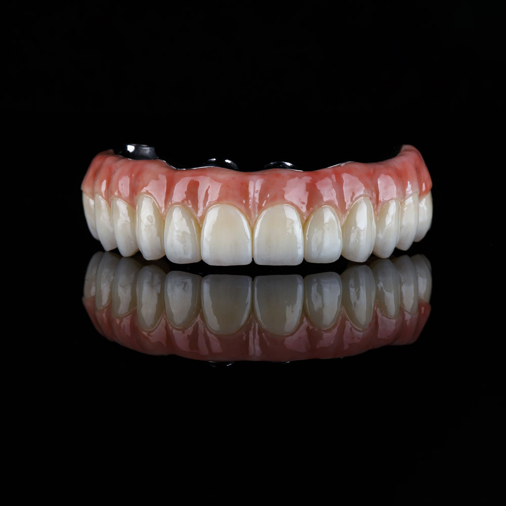 Implant supported dentures