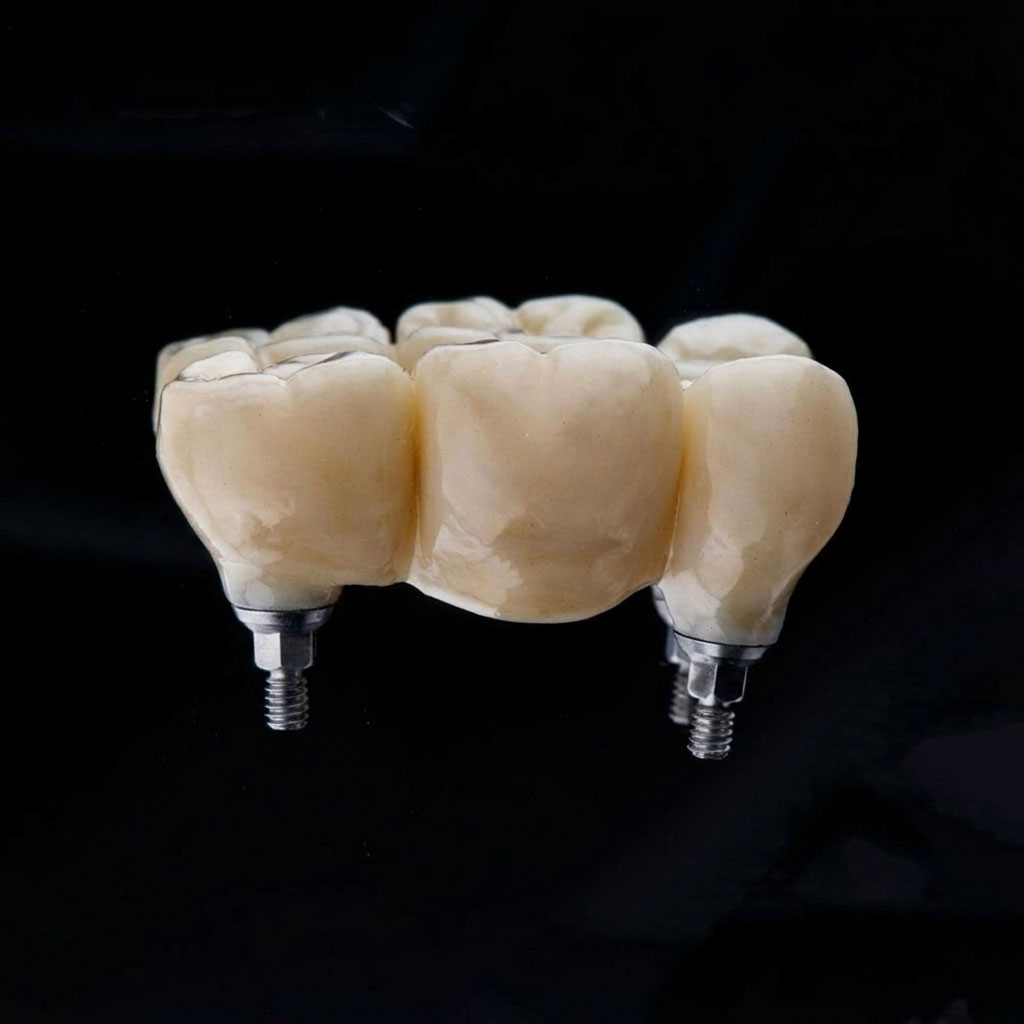 Dental bridge
