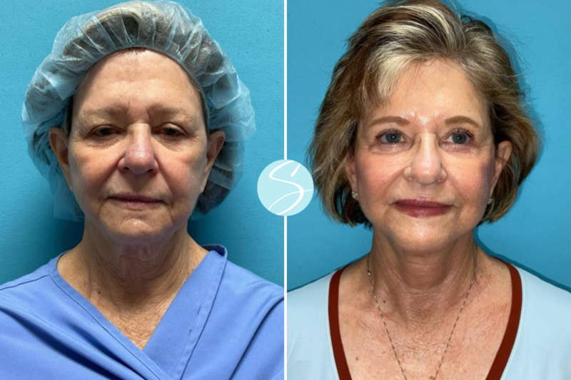 Real Patient Facelift Before & After