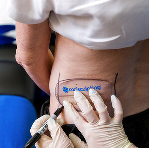 coolsculpting consultation