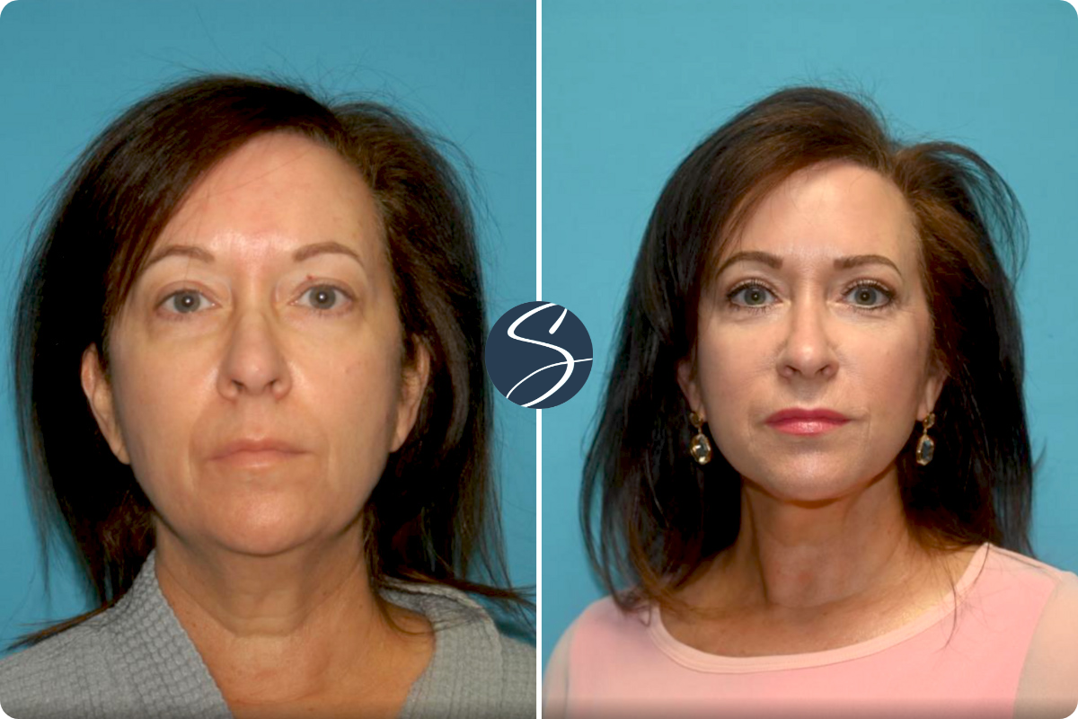 Real Patient Facelift Before & After