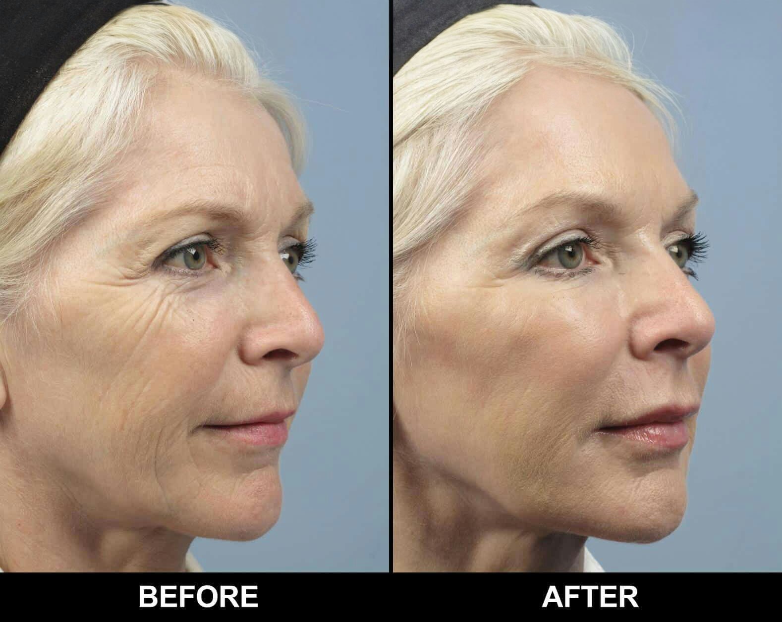 before and after laser treatment