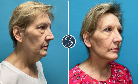 before and after profile view