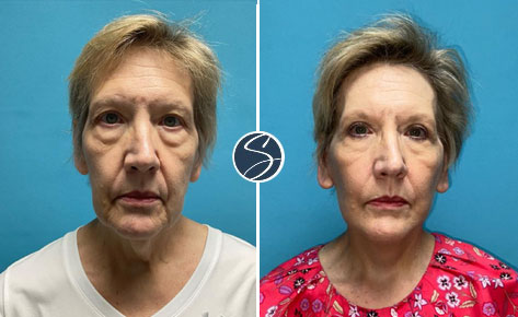 patient before and after