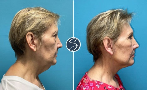 before and after side view