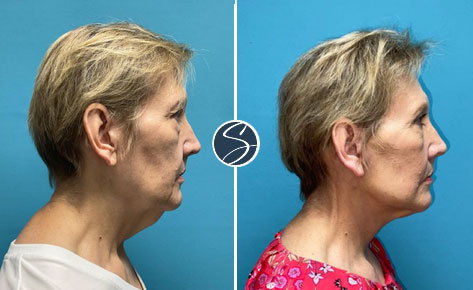 before and after side view