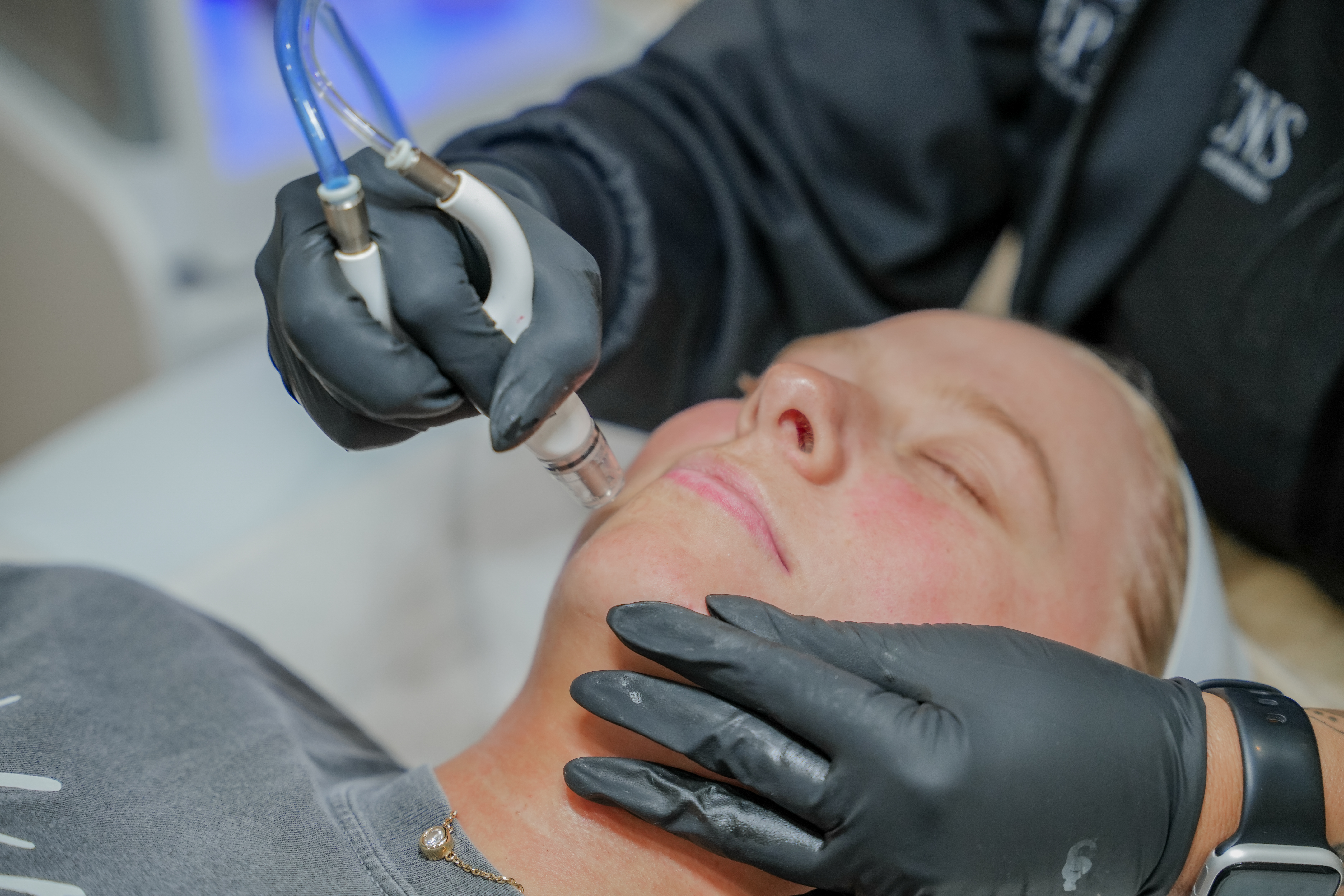 Staff showing patient microneedling tool