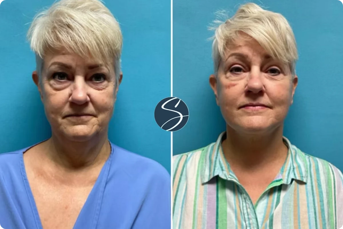Patient before and after facelift showing renewed skin tightness and youthful fullness in the face
