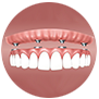 All-on-4 implants