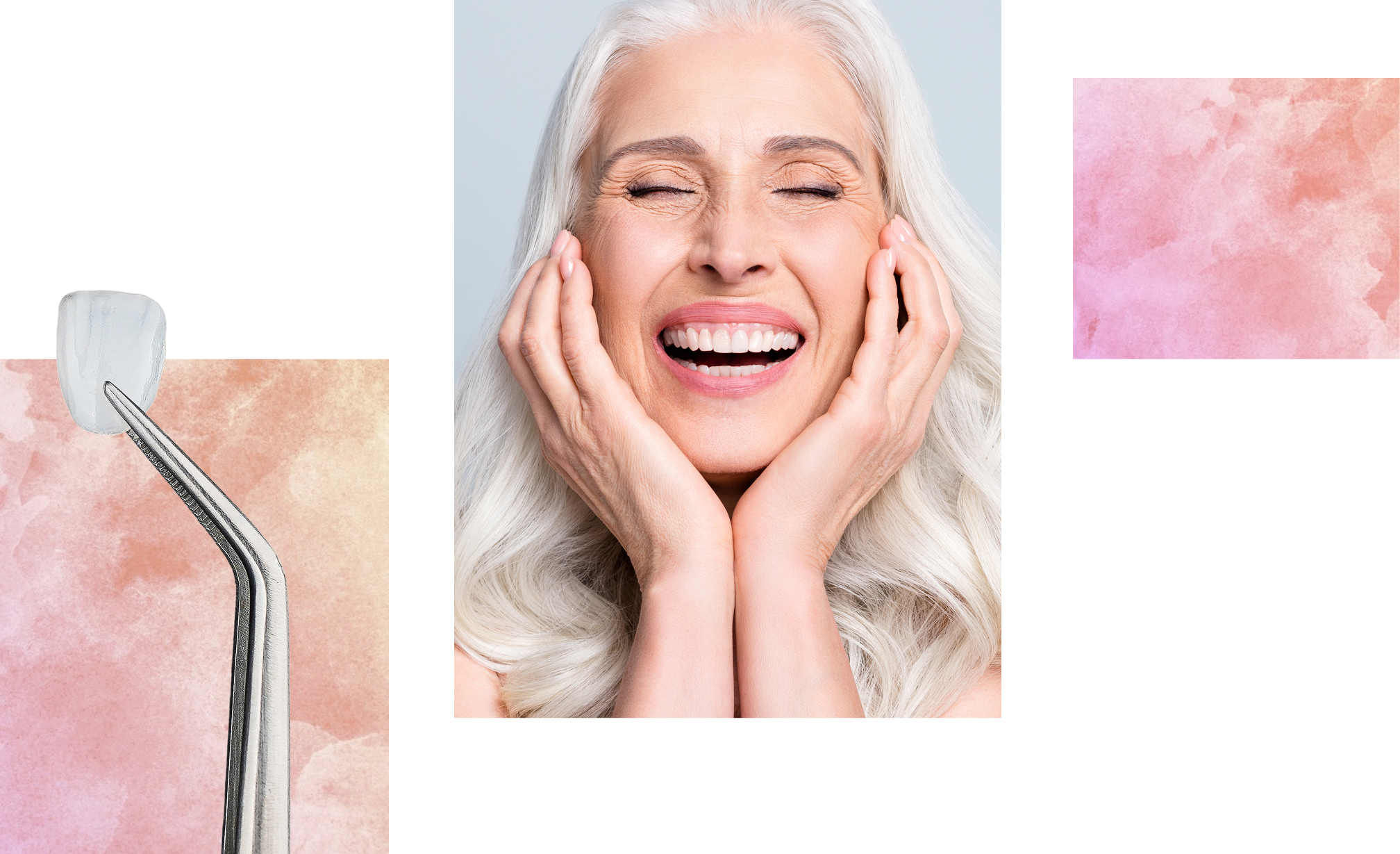 collage of smiling patient and veneer