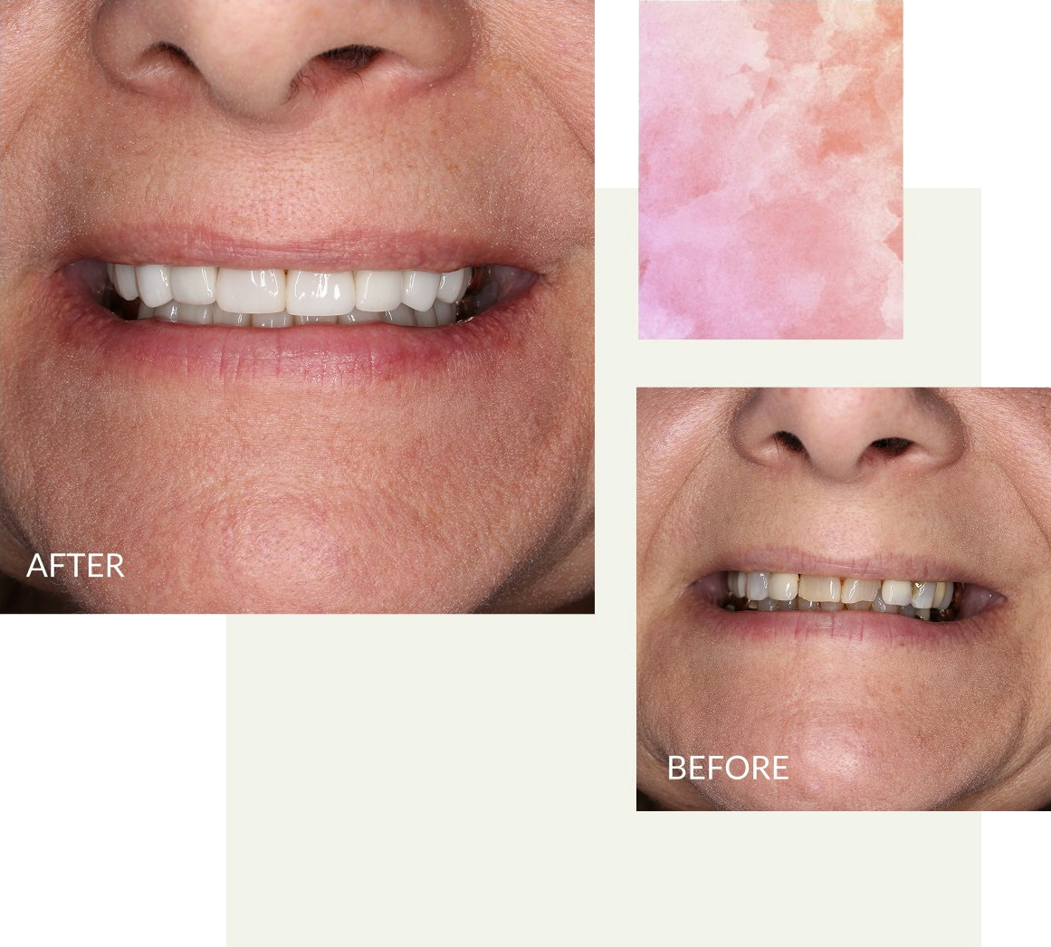 Elizabethtown woman before and after smile makeover