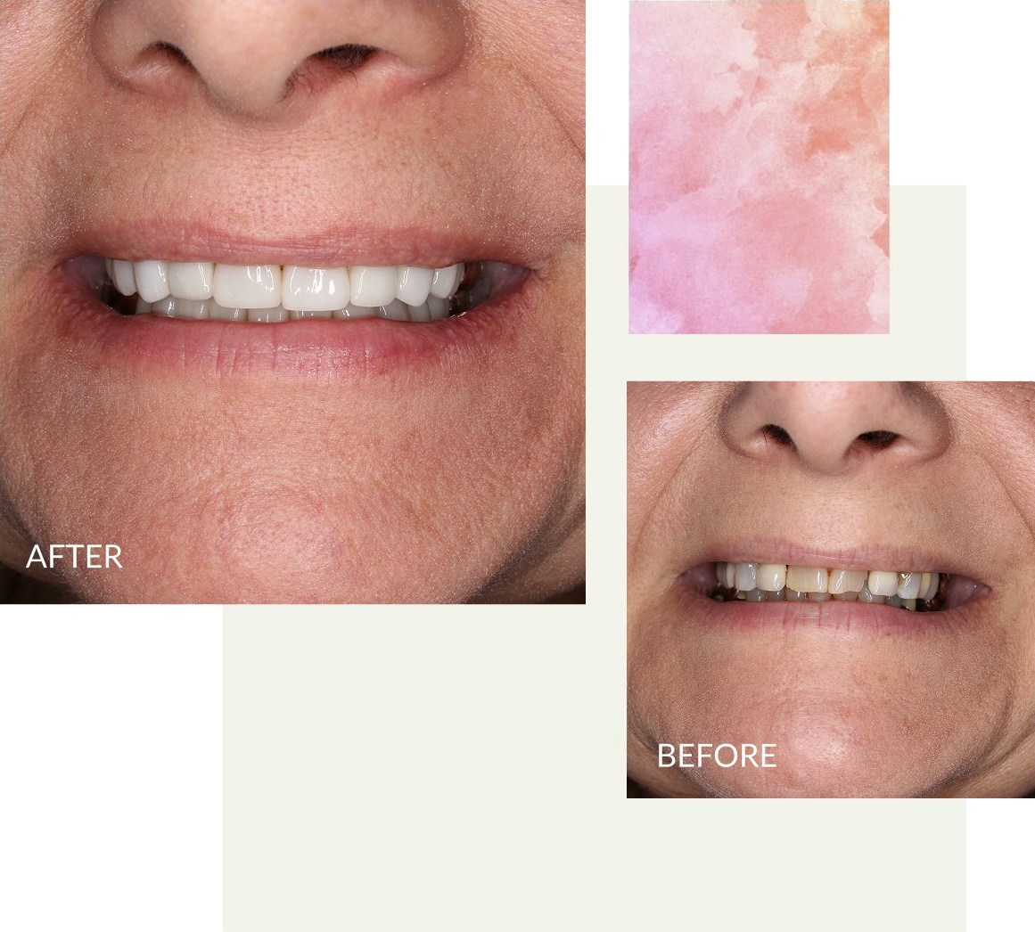 Elizabethtown woman before and after smile makeover