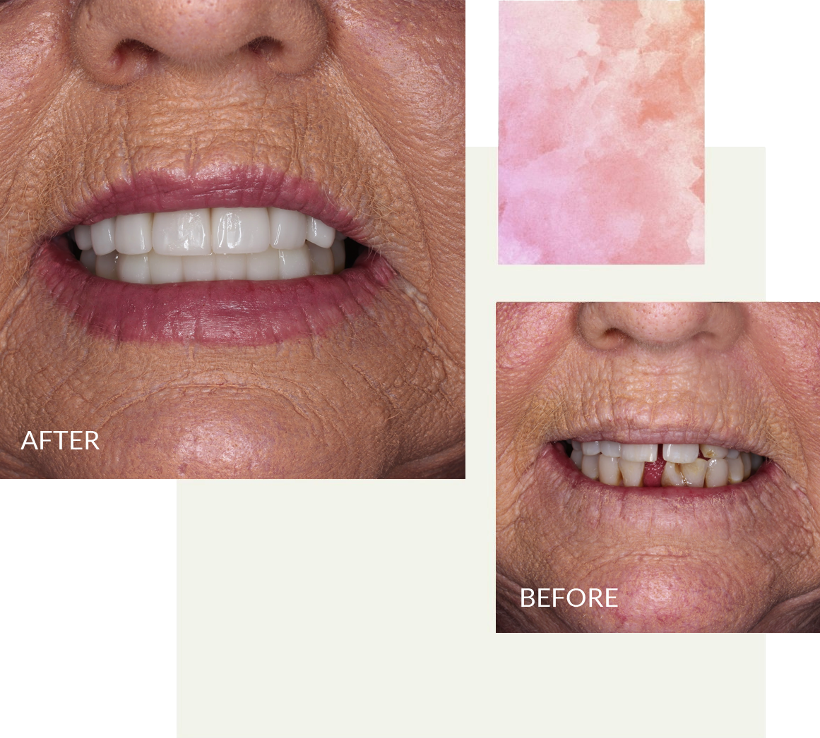 collage of patient before and after a smile makeover