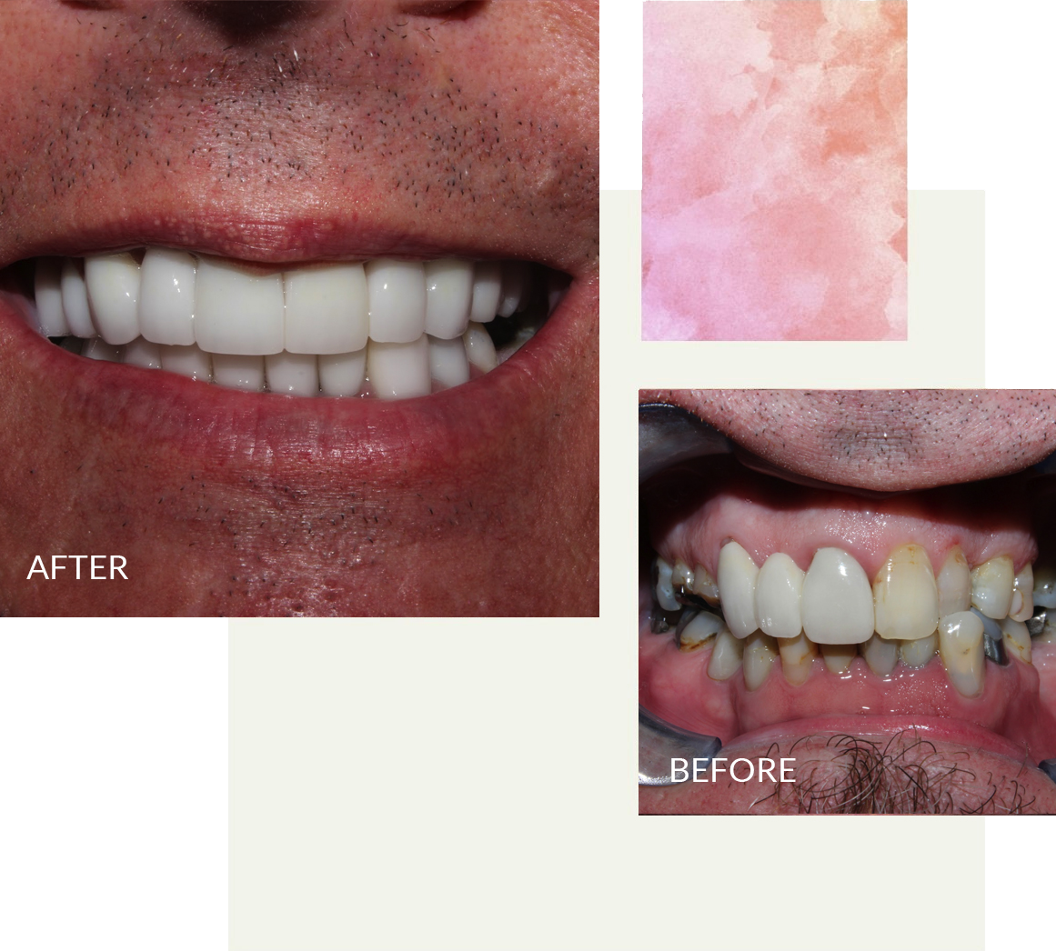 Before and after veneers