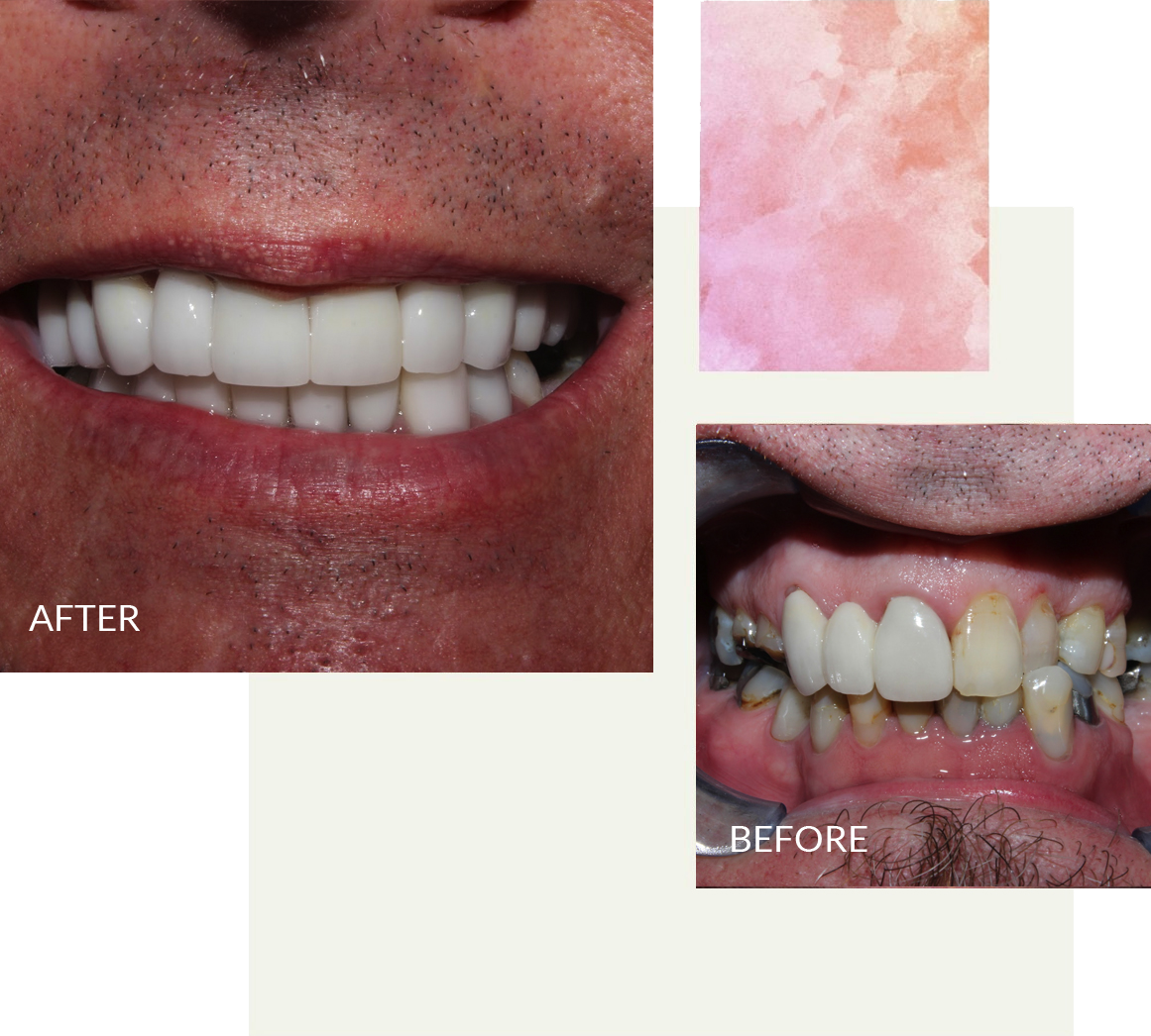 Before and after veneers