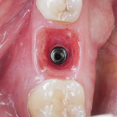 Implant in the gums