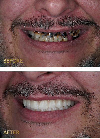 Before and after dental implants