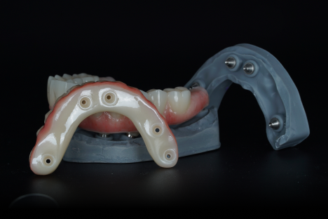 Implant dentures