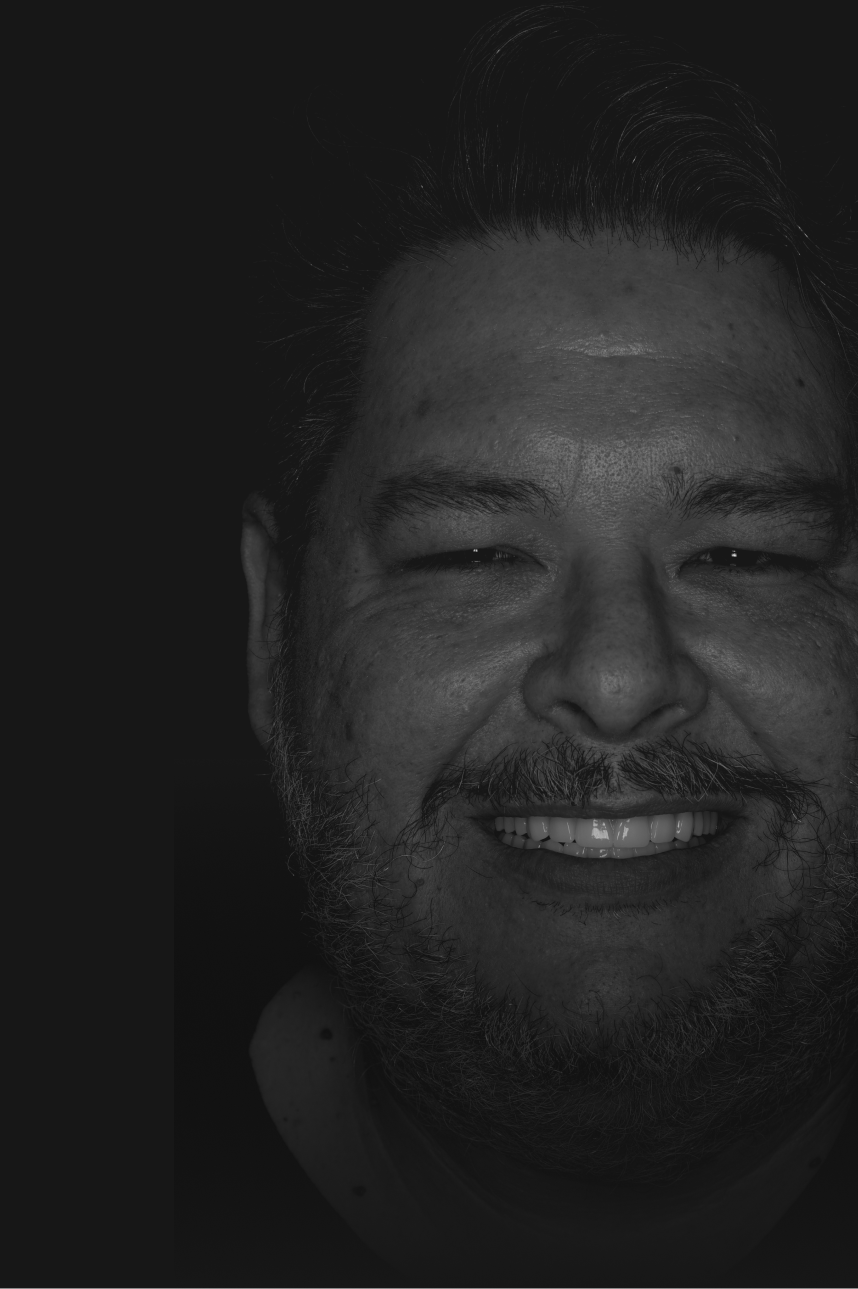 Before and after dental implants