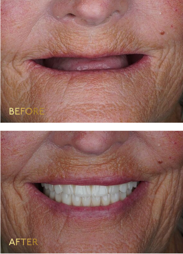 All-on-4 result — Eleve Dental Lubbock