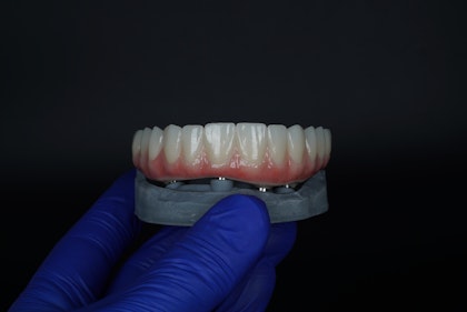 Implant-supported dentures