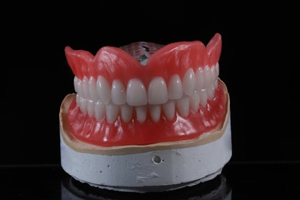 snap on dentures