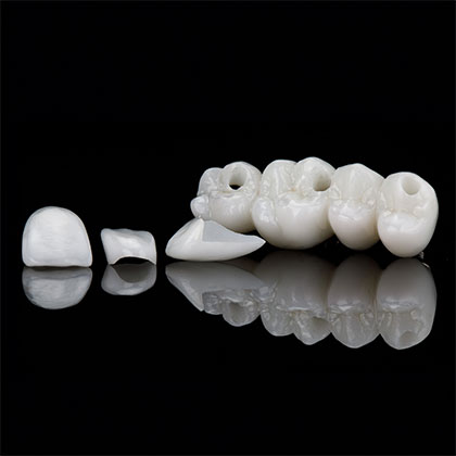 implant bridge, veneer, dental crown