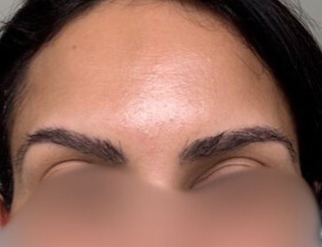 Woman with thick, full brows after an eyebrow transplant