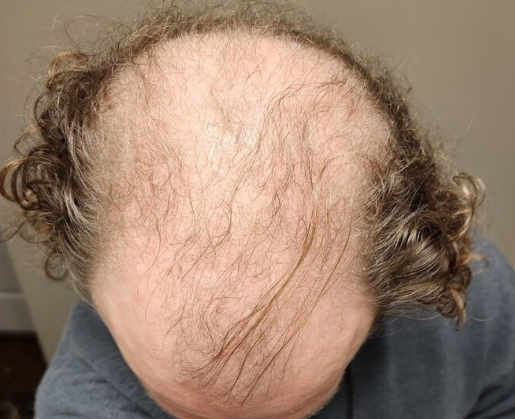 balding man with curly hair before FUE