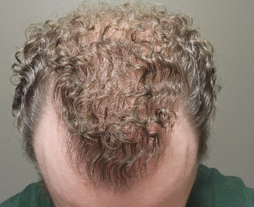 man with full head of curly hair after FUE