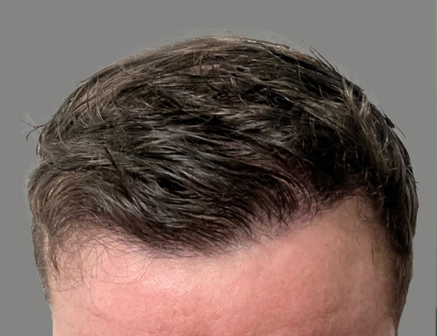 Man with full head of hair after FUE surgery