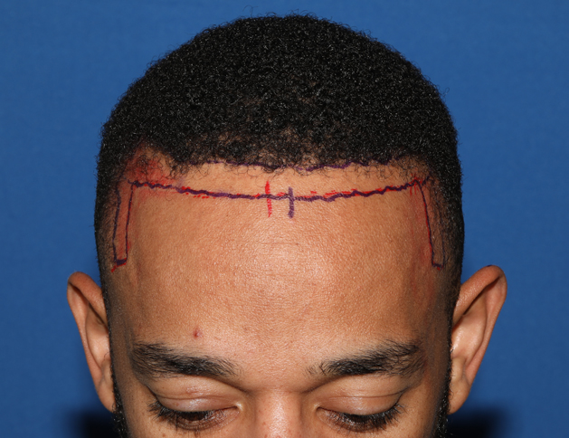 African American Hair Transplant