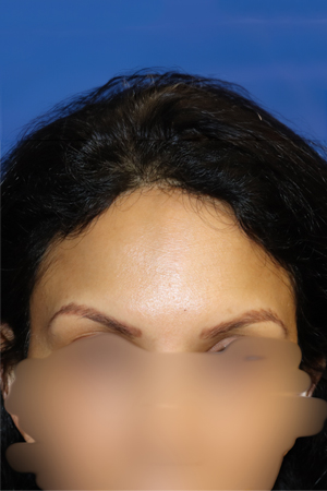 before and after eyebrow restoration