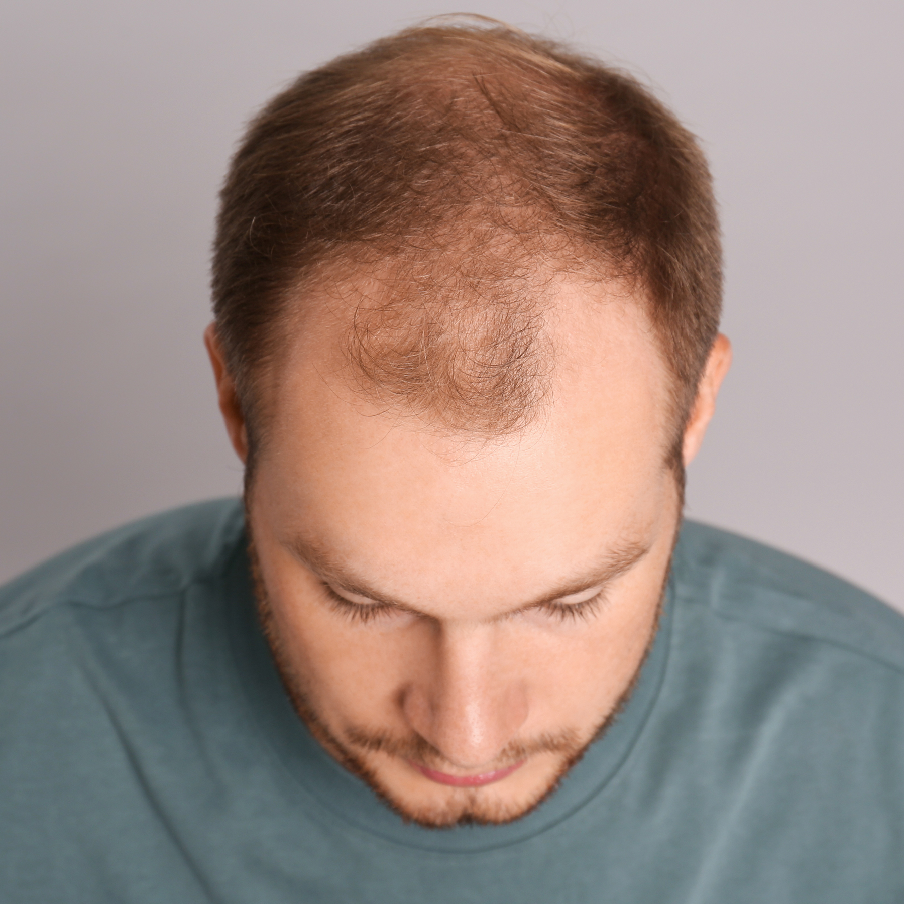 man with thinning hair