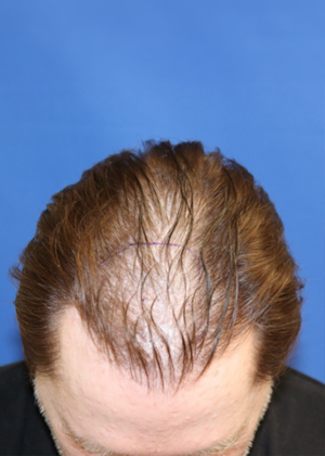 thin scalp hair before FUE