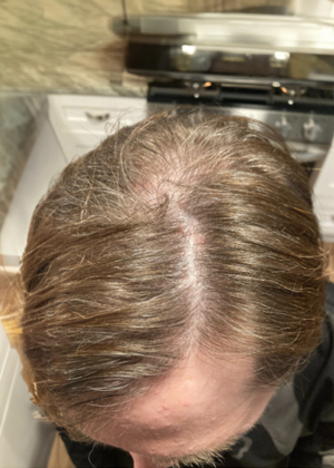 full scalp hair after FUE