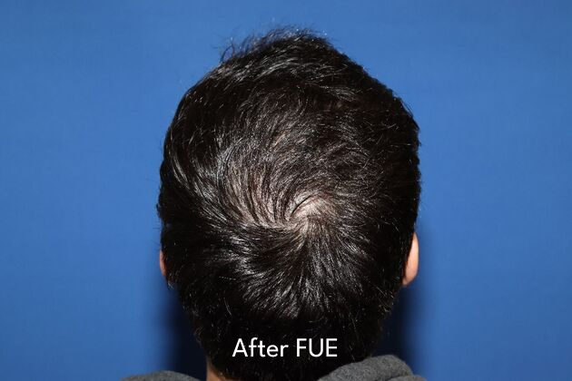 patient after FUE