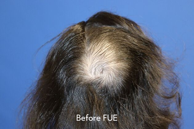 patient before FUE