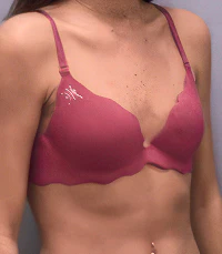 before breast augmentation