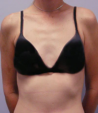 before breast implants
