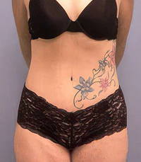 after tummy tuck