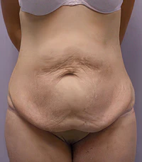 before tummy tuck